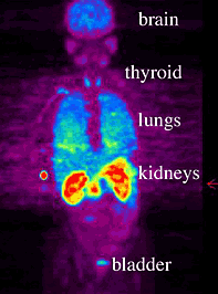 PET scan image