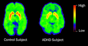 PET scans