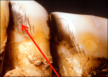 Isabella's teeth