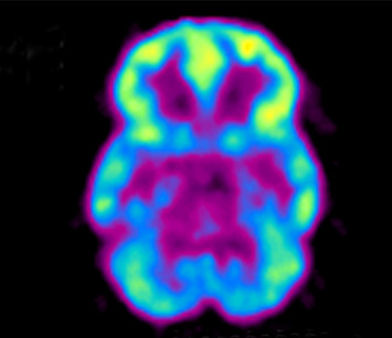 PET brain scan