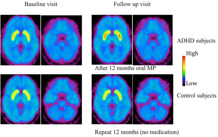 dopamine transporter levels