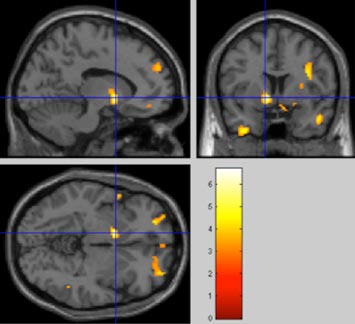 brain's reward regions