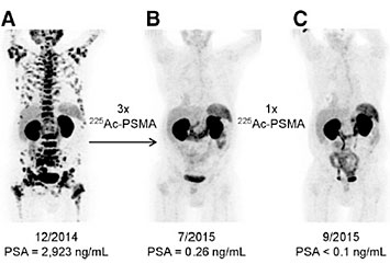 picture shows three different images of a single patient with end-stage prostate cancer