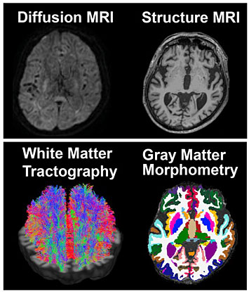 MRI Images