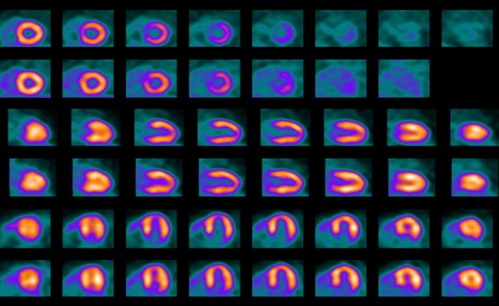 Heart scans