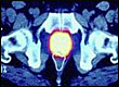 Energy Deposited at a Tumor From Proton Therapy