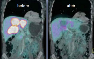 photo of liver lesions